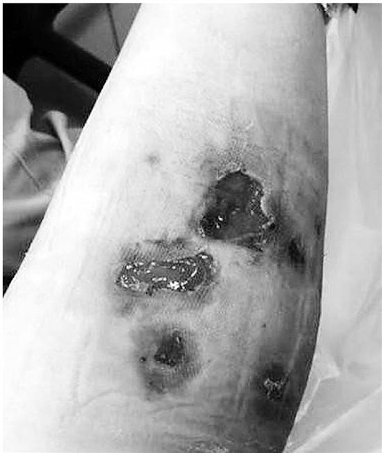 可怕!28岁姑娘注射"瘦腿针" 腿部溃烂险截肢